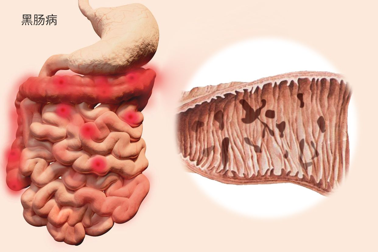 黑肠病图片