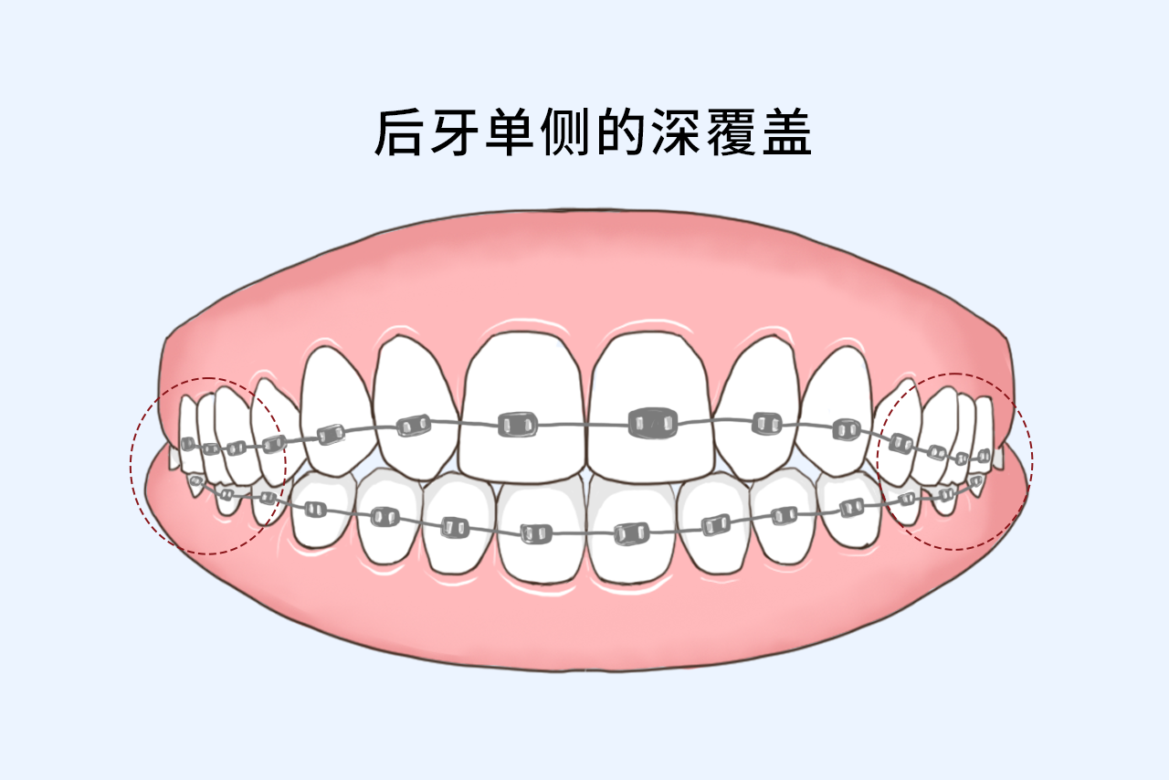 后牙单侧的深覆盖如何矫正图片