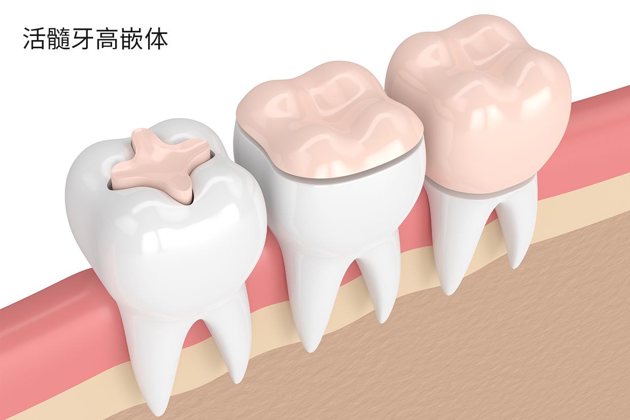 活髓牙高嵌体图片