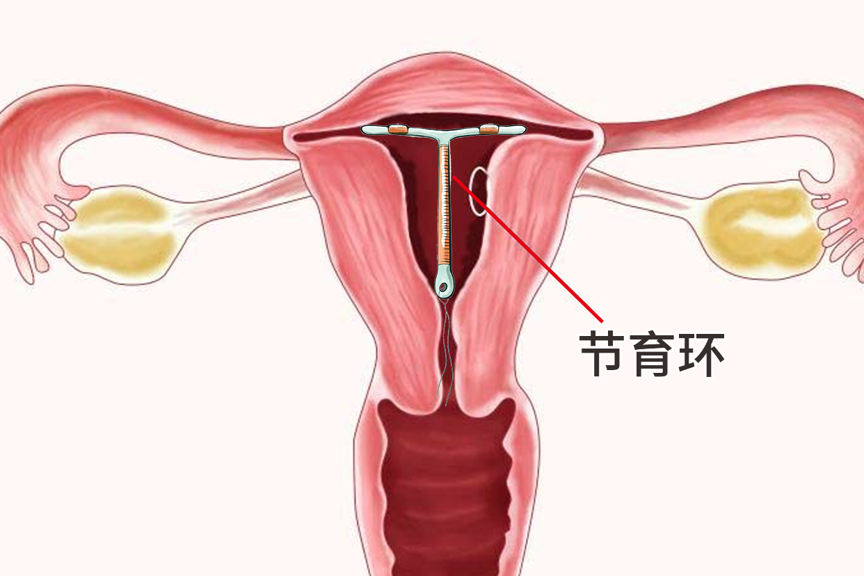 有女人上怀的子宫图片吗 女人上环有几种