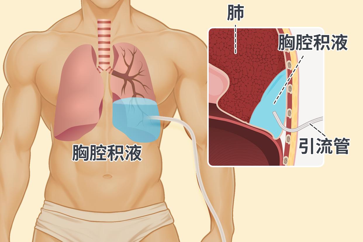 胸膜炎伤口引流管的位置图片 胸膜炎引流后 ,还感觉气紧是为什么