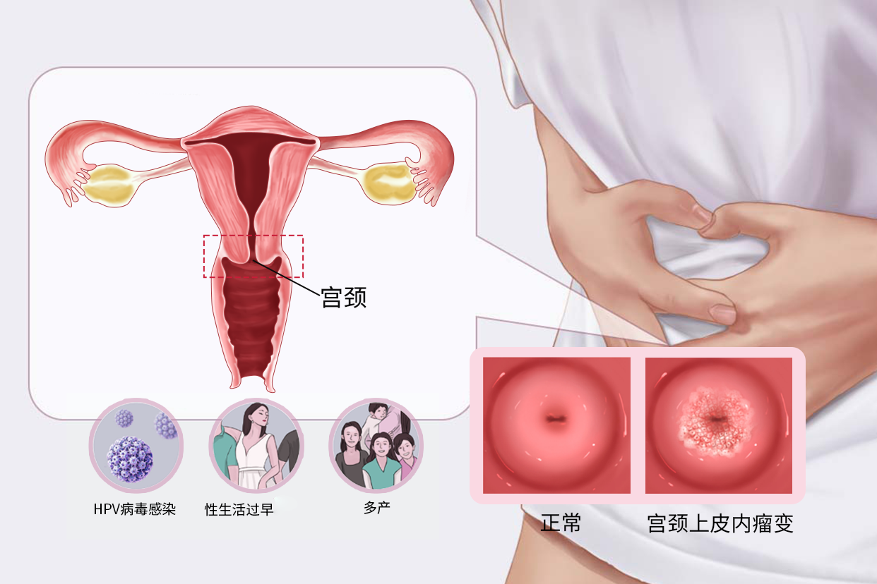 宫颈瘤样病变图片 宫颈瘤样病变图片高清