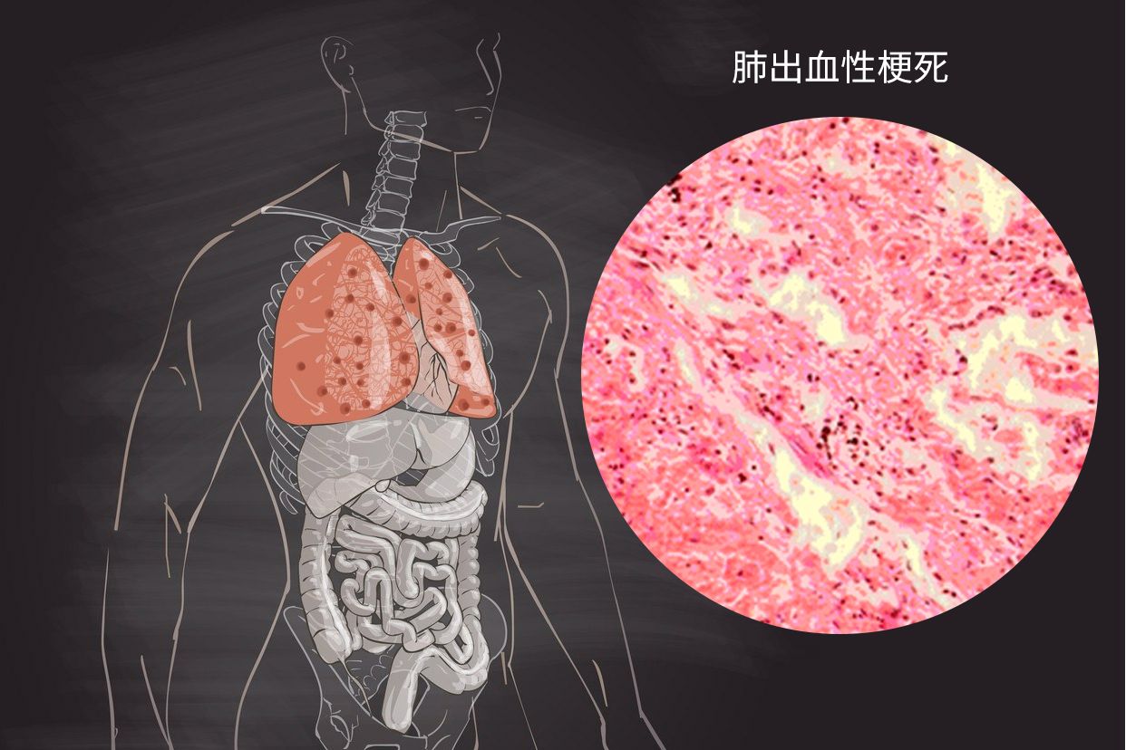 肺出血性梗死图片手绘图 肺出血性梗死图片手绘图大全