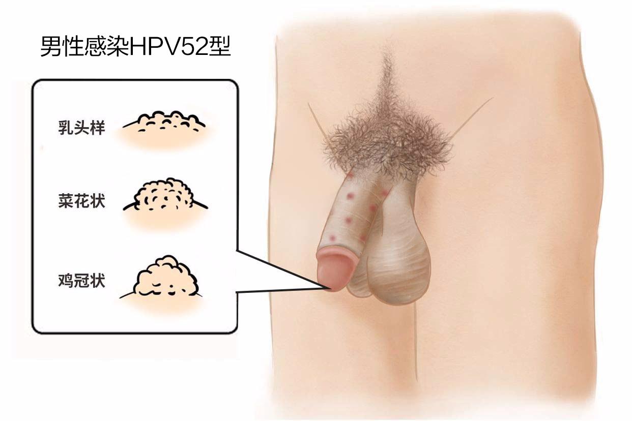 hpv52疣体长什么样（感染hpv52疣体会长在哪）