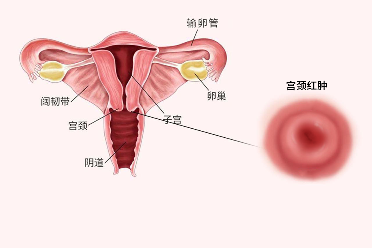 宫颈红肿图片（宫颈红肿图片高清）