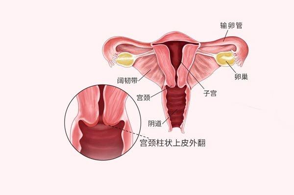 宫颈口外翻是怎么回事图片 宫颈口外翻如何治疗