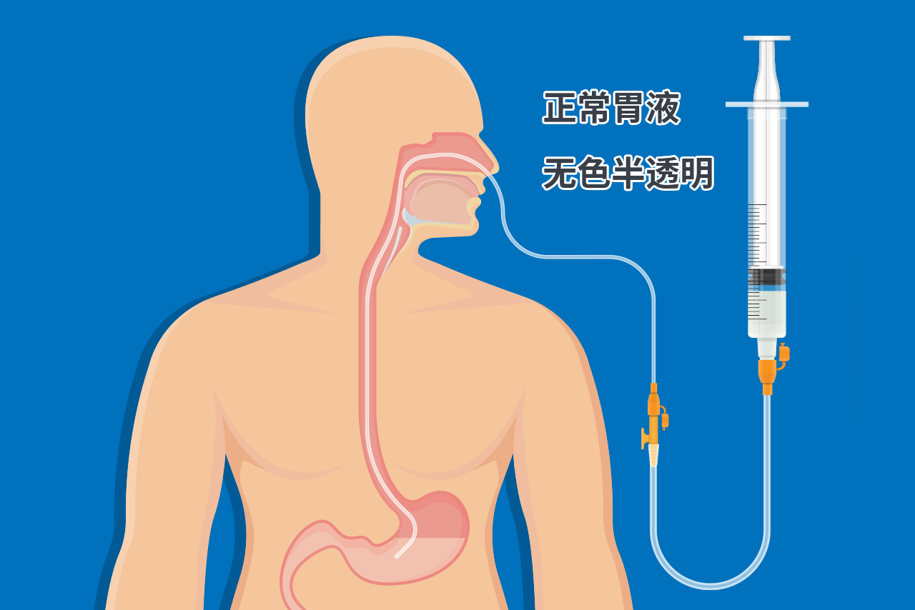 正常胃液颜色的图片 正常胃液的性状