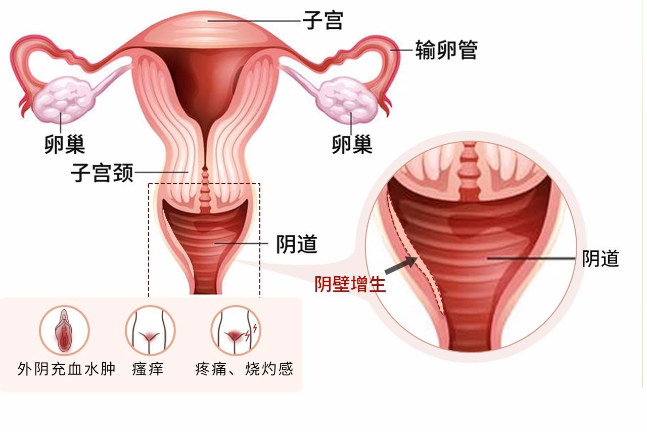 阴壁增生症状图片（阴壁增生怎么发现）