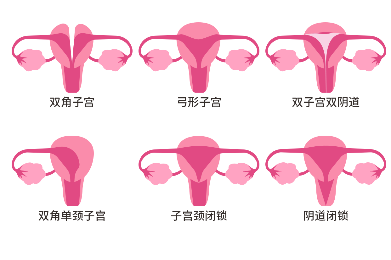 残角子宫示意图 残角子宫可以要孩子吗