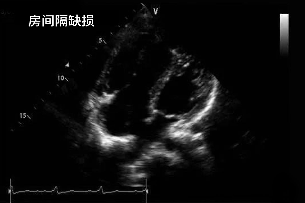 房间隔缺损超声心动图的特征（房间隔缺损超声心动图的特征是）