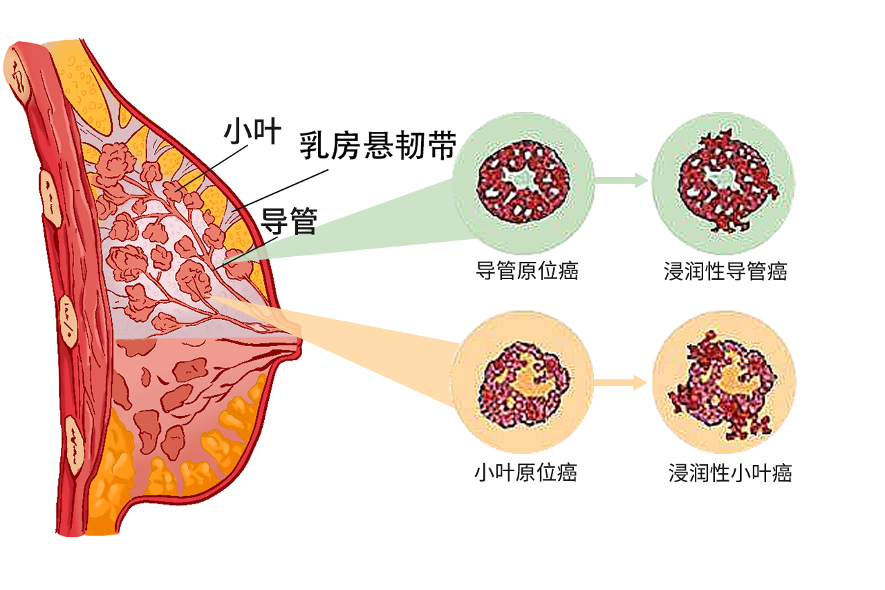 浸润性乳腺癌的图片和症状有哪些 浸润性乳腺癌的特征