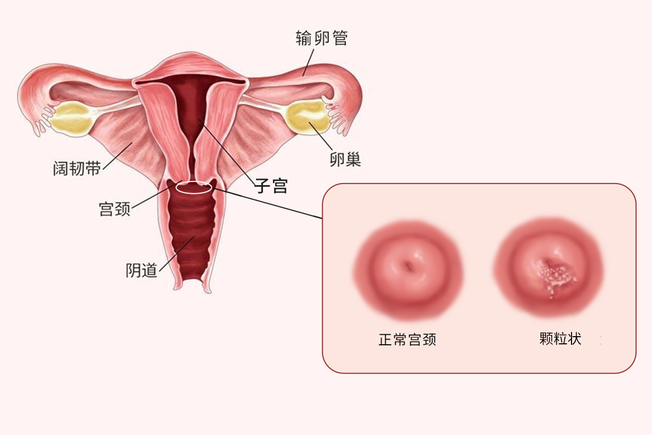 宫颈糜烂颗粒状图片 宫颈糜烂颗粒状怎么办