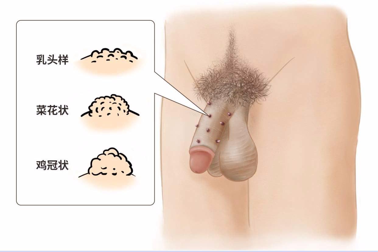 hpv6疣体长什么样（hpv6长疣体会转阴吗）