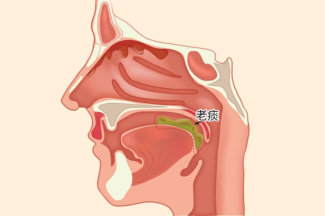 老痰图片 老痰什么意思