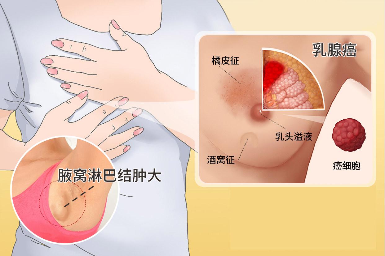 乳腺癌早期腋窝淋巴结肿大真人图片（乳腺癌早期症状腋窝淋巴有变化吗）