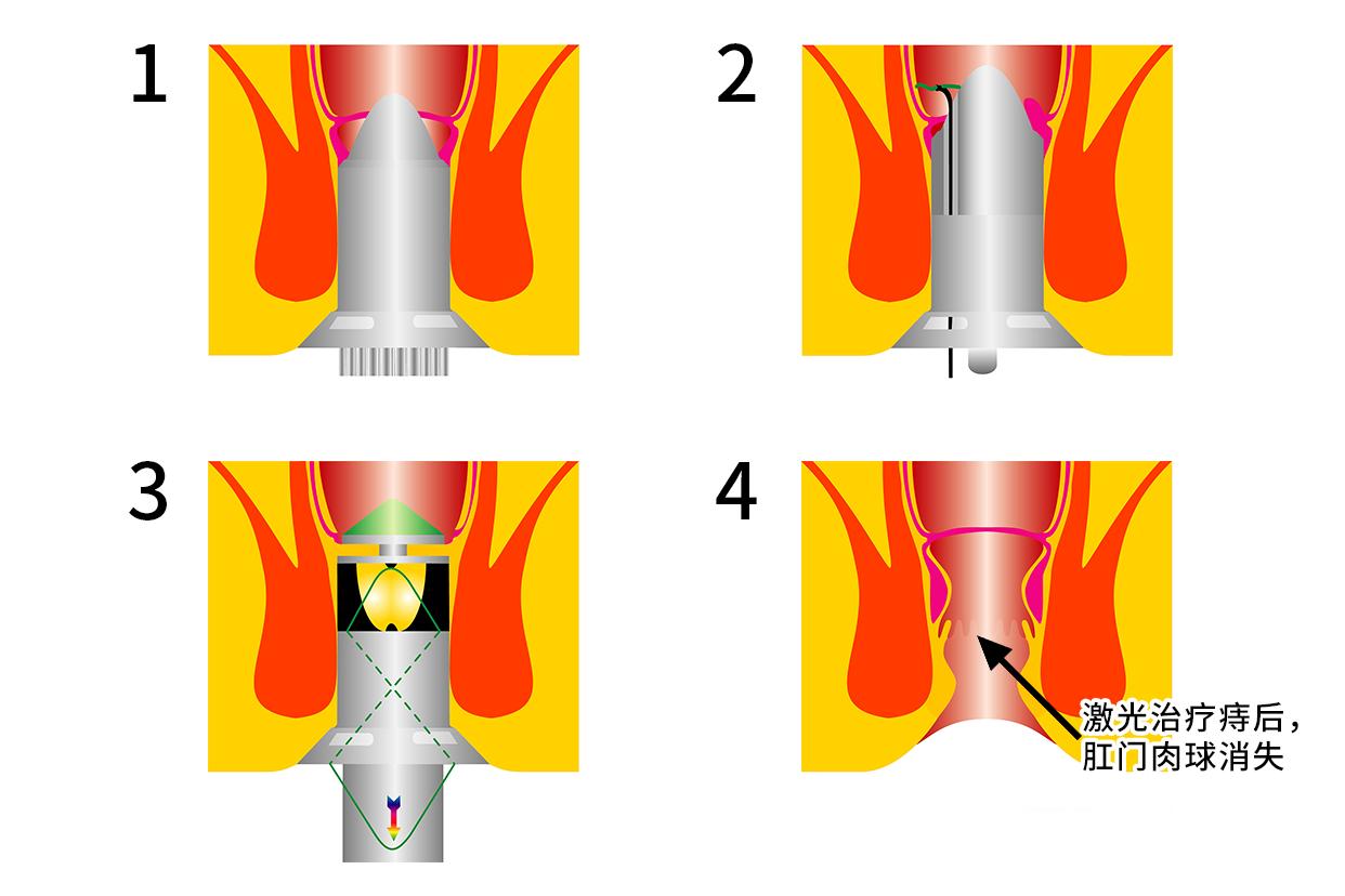 痔疮激光术后肛门口肉球图 刚刚做完激光痔疮手术现在特别疼
