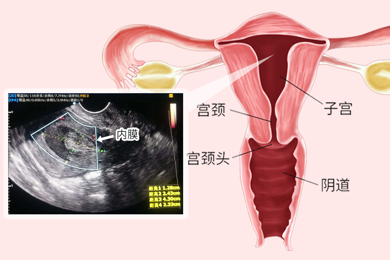 子宫内膜彩超图解 子宫内膜彩超图解图片