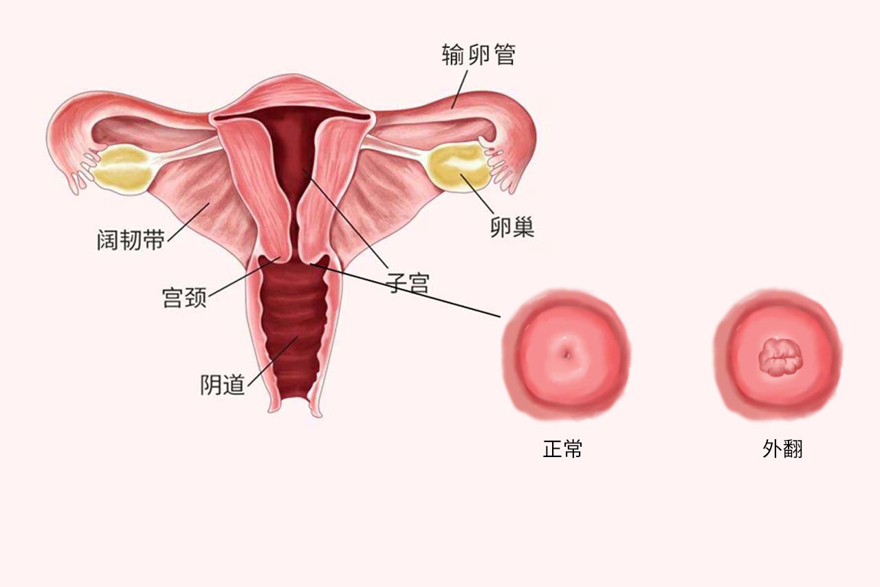 宫颈外翻图片 宫颈外翻图片实图