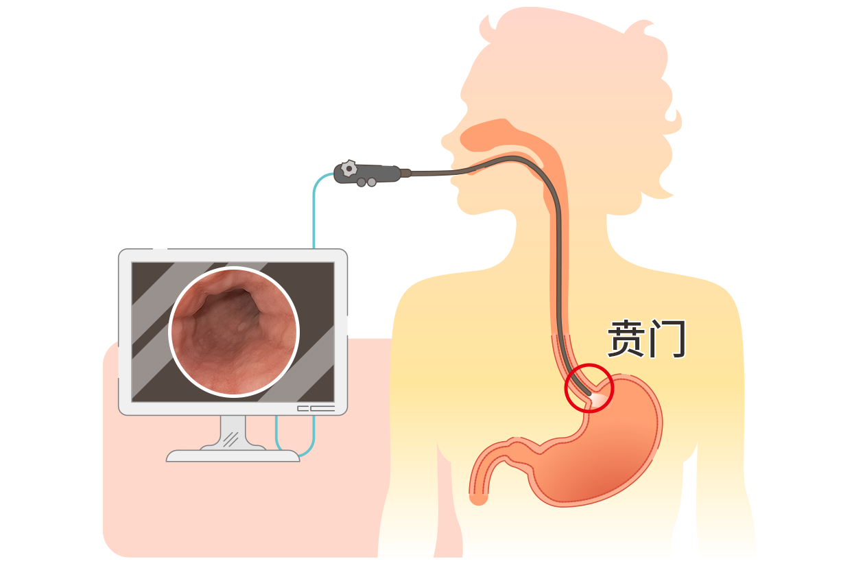 胃镜正常的贲门图片