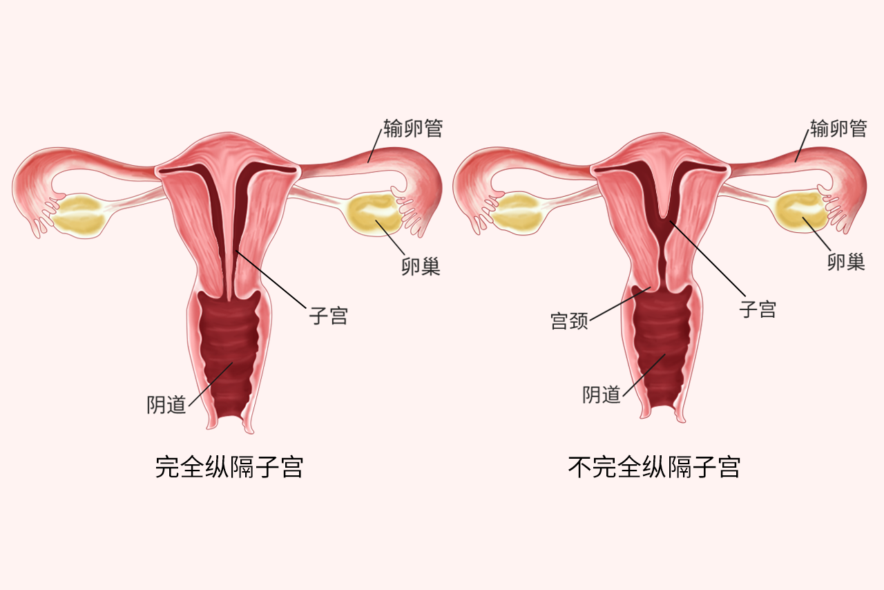 重隔子宫图片