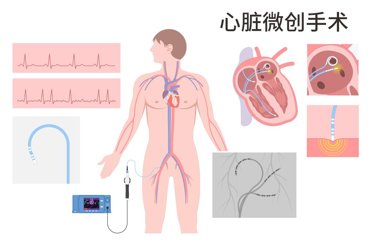 微创手术是什么样的，心脏彩超是怎样