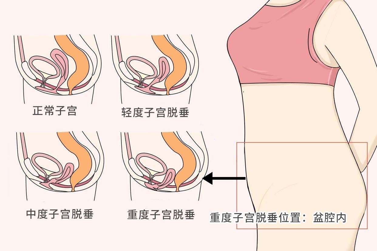 宫颈上吊严重位置在哪呢图片