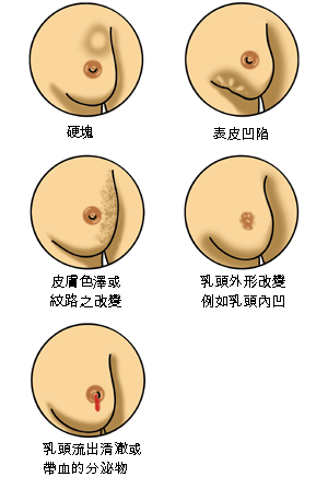 乳腺癌（乳腺癌早期的症状有哪些）